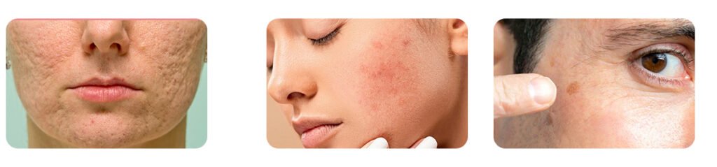 Types of Acne Scars
