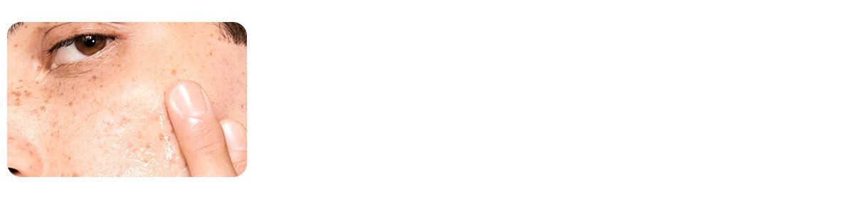 Controls Excess Oil and Prevents Acne