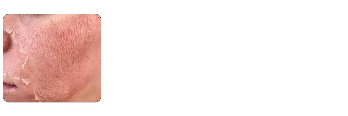 Peeling and Skin Renewal