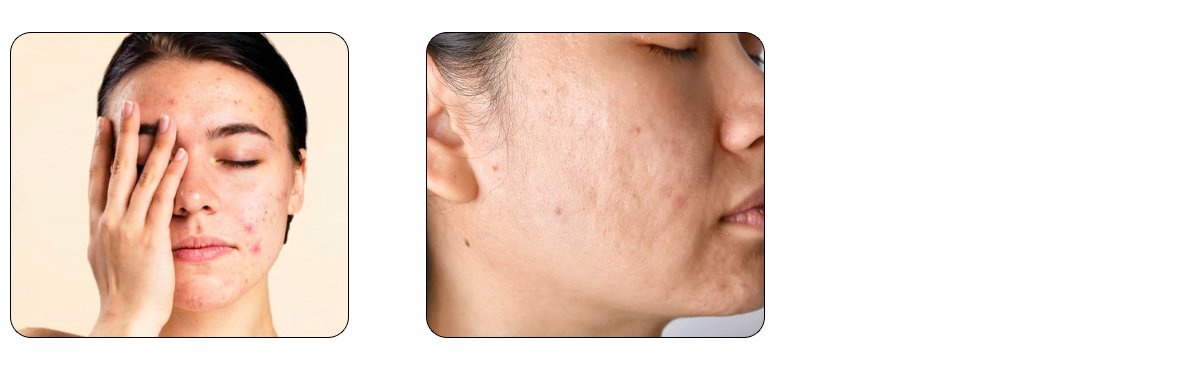 Minimizing scars, acne marks, and pigmentation