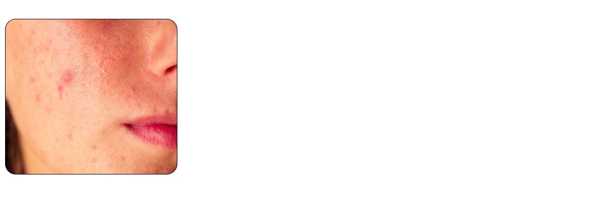 Minimizes Acne Scars and Hyperpigmentation