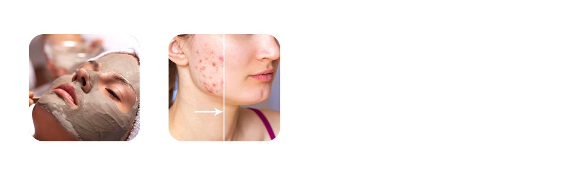 Acne Control Facial 