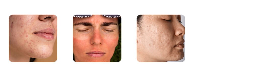 common skin issues for wheatish skin tone