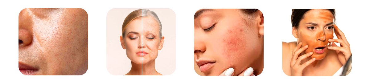 what causes open pores