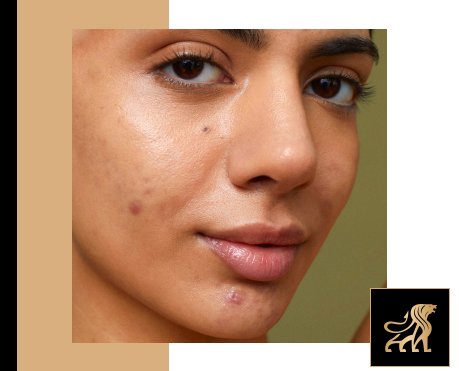 best sunscreen for oily skin Main Image