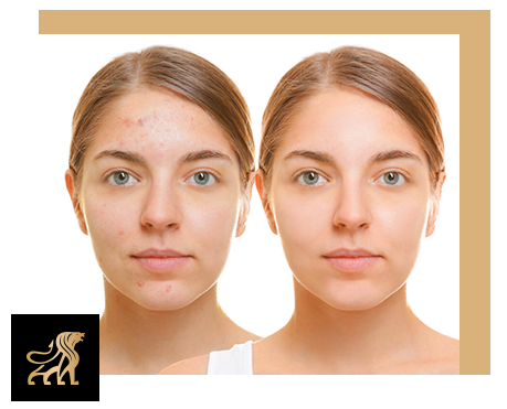 Hydra facial mai image