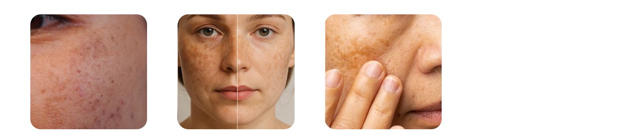symptoms of melasma 