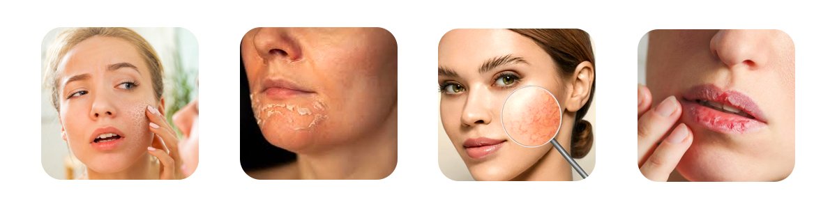 the winter skin struggle