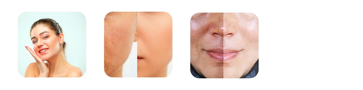 benefits of carbon laser peel