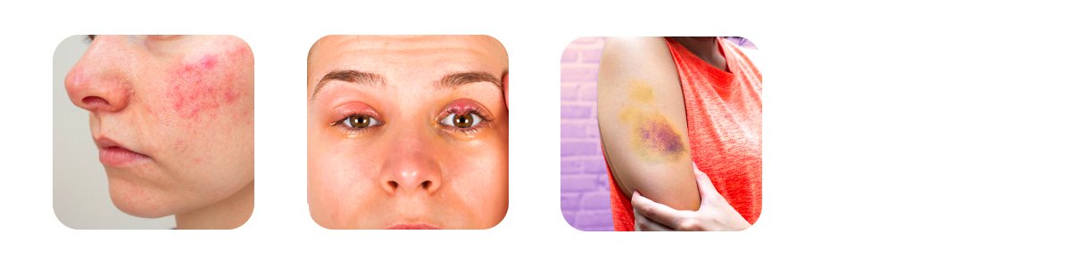 what to expect after rejuran