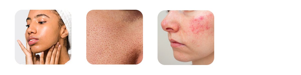 sugar and acne a direct connection