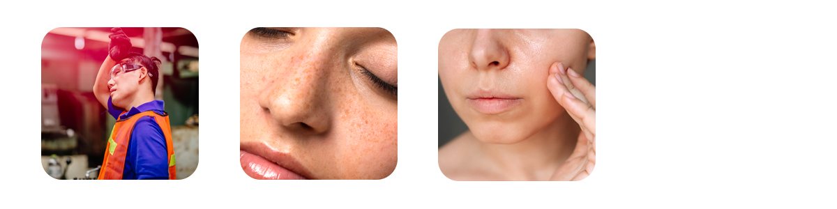 why pigmentation changes with seasons