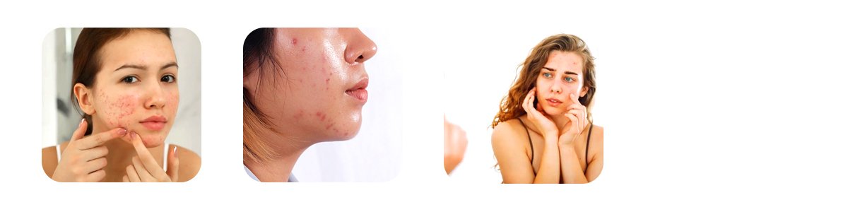 who should consider smart photodynamic therapy